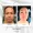 Dailyglowspa_Before_and_After_Aviclear_One_in_San_Diego_CA